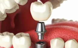 Особенности протезирования в стоматологии